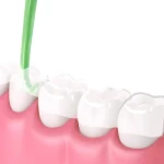 Professional Easy-to-Use Dental Retainer Removal Tool