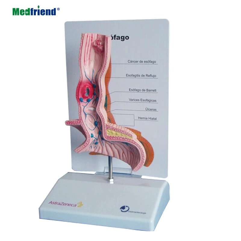 Medical Anatomical Diseased Esophageal Model