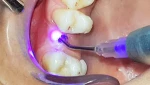 Surgical diode lasers dental laser equipment