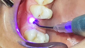 Surgical diode lasers dental laser equipment