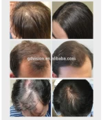 Private Label Hair Products Treatment Of Hair loss